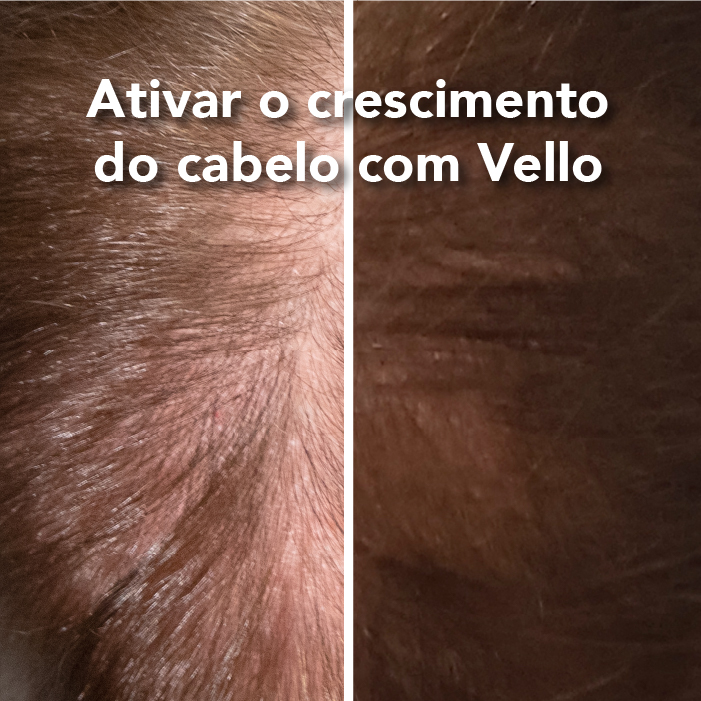 Antes e depois do tratamento Vello